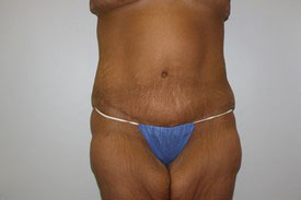 Tummy Tuck Before and After Pictures Birmingham, AL