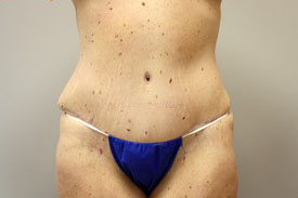 Tummy Tuck Before and After Pictures Birmingham, AL