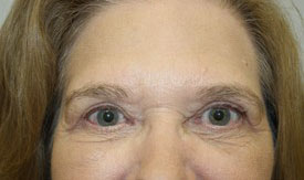 Blepharoplasty Before and After Pictures Birmingham, AL