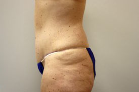 Tummy Tuck Before and After Pictures Birmingham, AL