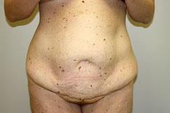 Tummy Tuck Before and After Pictures Birmingham, AL