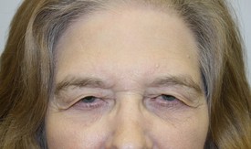 Blepharoplasty Before and After Pictures Birmingham, AL