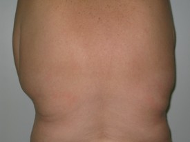 Laser Lipo with SlimLipo Before and After Pictures Birmingham, AL