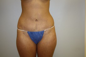 Tummy Tuck Before and After Pictures Birmingham, AL