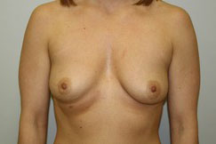 Breast Augmentation Before and After Pictures Birmingham, AL