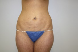 Tummy Tuck Before and After Pictures Birmingham, AL