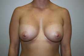 Breast Augmentation Before and After Pictures Birmingham, AL