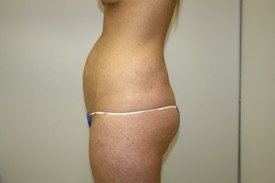 Tummy Tuck Before and After Pictures Birmingham, AL