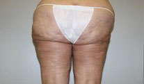 Laser Lipo with SlimLipo Before and After Pictures Birmingham, AL
