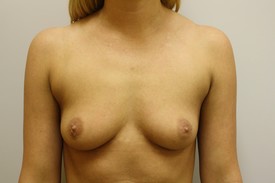 Breast Augmentation Before and After Pictures Birmingham, AL