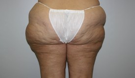 Laser Lipo with SlimLipo Before and After Pictures Birmingham, AL