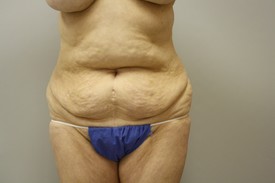 Tummy Tuck Before and After Pictures Birmingham, AL