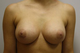 Breast Augmentation Before and After Pictures Birmingham, AL