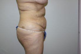 Tummy Tuck Before and After Pictures Birmingham, AL