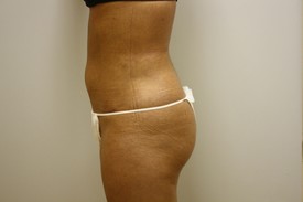 Laser Lipo with SlimLipo Before and After Pictures Birmingham, AL