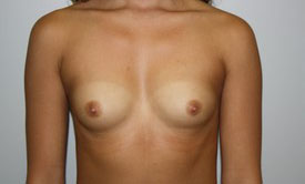 Breast Augmentation Before and After Pictures Birmingham, AL