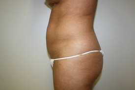 Laser Lipo with SlimLipo Before and After Pictures Birmingham, AL