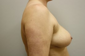 Breast Reduction in Birmingham, AL