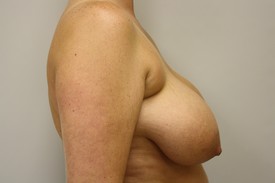 Breast Reduction Before and After Pictures Birmingham, AL