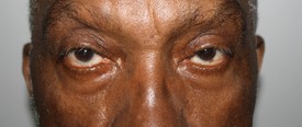 Blepharoplasty Before and After Pictures Birmingham, AL