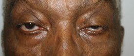 Blepharoplasty Before and After Pictures Birmingham, AL