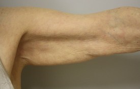 Brachioplasty Before and After Pictures Birmingham, AL