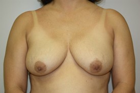 Breast Lift Before and After Pictures Birmingham, AL