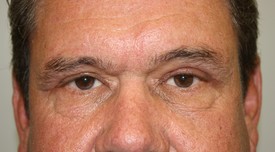 Blepharoplasty Before and After Pictures Birmingham, AL