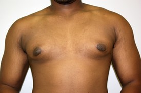 Gynecomastia Before and After Pictures Birmingham, AL