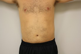 Laser Lipo with SlimLipo Before and After Pictures Birmingham, AL