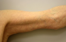 Brachioplasty Before and After Pictures Birmingham, AL