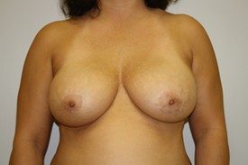 Breast Lift Before and After Pictures Birmingham, AL