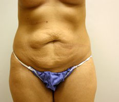 Tummy Tuck Before and After Pictures Birmingham, AL