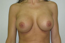 Breast Augmentation Before and After Pictures Birmingham, AL