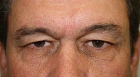 Blepharoplasty Before and After Pictures Birmingham, AL