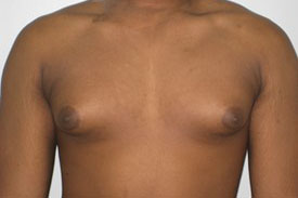 Gynecomastia Before and After Pictures Birmingham, AL