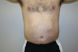 Laser Lipo with SlimLipo Before and After Pictures Birmingham, AL