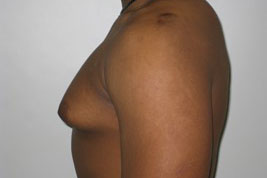 Gynecomastia Before and After Pictures Birmingham, AL