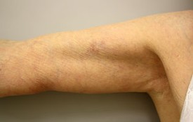 Brachioplasty Before and After Pictures Birmingham, AL