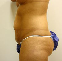 Tummy Tuck Before and After Pictures Birmingham, AL