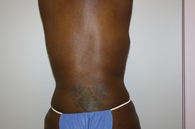 Laser Lipo with SlimLipo Before and After Pictures Birmingham, AL