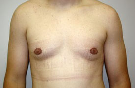 Gynecomastia Before and After Pictures Birmingham, AL