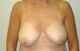 Breast Lift Before and After Pictures Birmingham, AL