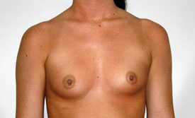 Breast Augmentation Before and After Pictures Birmingham, AL