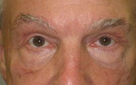 Blepharoplasty Before and After Pictures Birmingham, AL