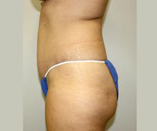Tummy Tuck Before and After Pictures Birmingham, AL
