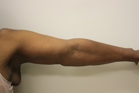 Brachioplasty Before and After Pictures Birmingham, AL