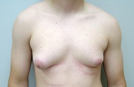 Gynecomastia Before and After Pictures Birmingham, AL