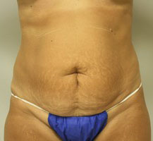 Tummy Tuck Before and After Pictures Birmingham, AL