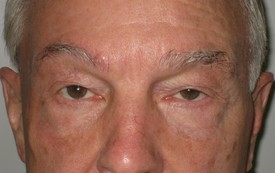 Blepharoplasty Before and After Pictures Birmingham, AL